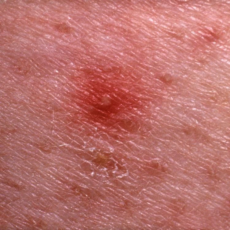 12 Bumps On Your Skin That You Should NEVER Pop