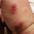 Do You Have A Spider Bite? These 7 Photos Can Help You Tell