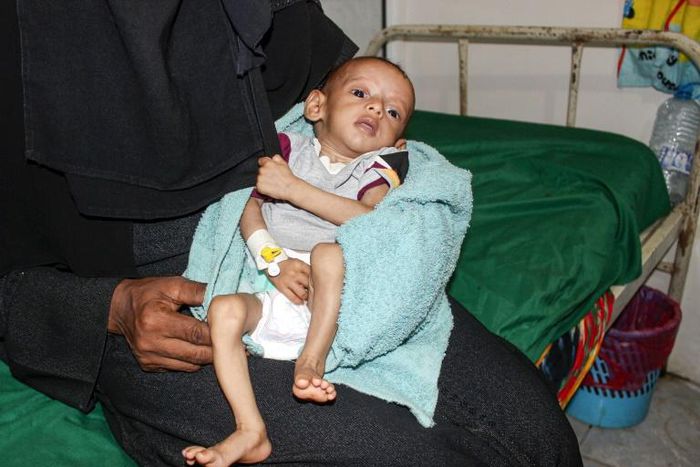 A malnourished child receiving treatment at a hospital in Yemen: a UN report said more than 821 million people worldwide suffered from hunger in 2018
