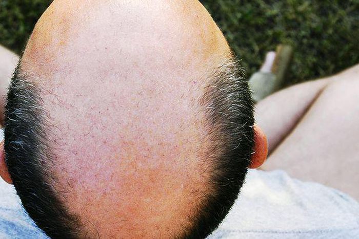 7 Ways to Slow Down Hair Loss
