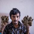 Abul Bajandar has had 25 operations since 2016 to remove growths from his hands and feet caused by a rare syndrome