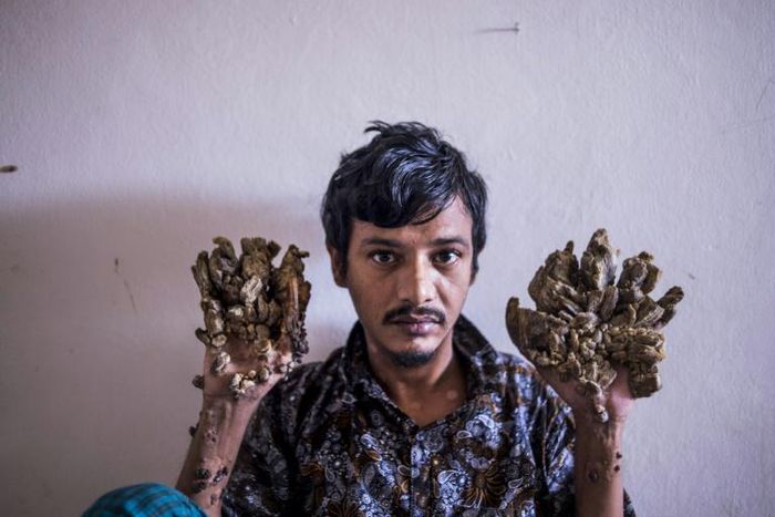 Abul Bajandar has had 25 operations since 2016 to remove growths from his hands and feet caused by a rare syndrome