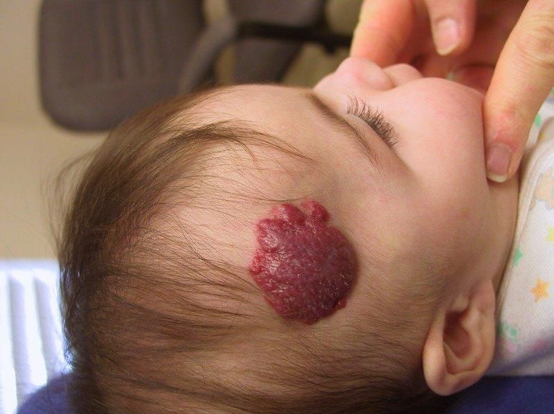 Strawberry marks. Source: Healthh.com
