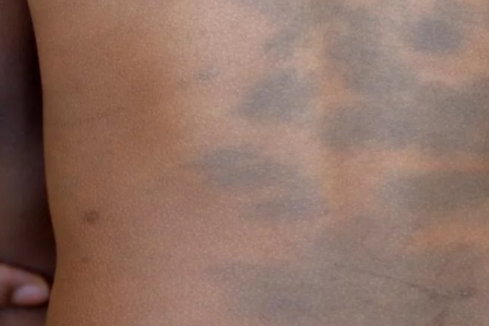 What is a birthmark: Everything you need to know