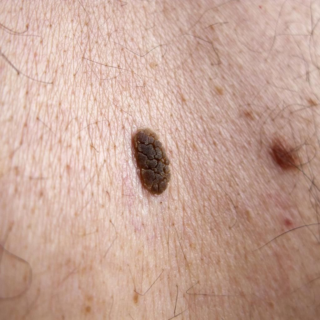 Seborrhoeic Keratosis