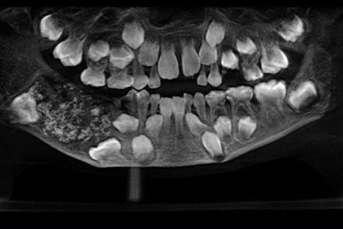 Doctors discover 526 extra teeth in 7-year-old boy’s mouth (photos)