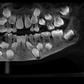 Doctors discover 526 extra teeth in 7-year-old boy’s mouth (photos)