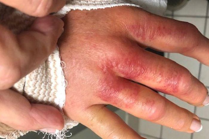 Woman Contracts Flesh-Eating Bacteria At Salon