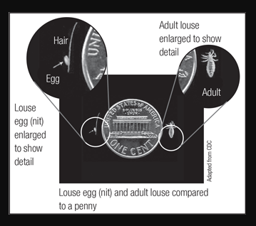 The best guide to head lice treatment for kids