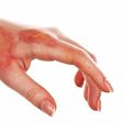 Here is how to heal burns in fast and safe ways