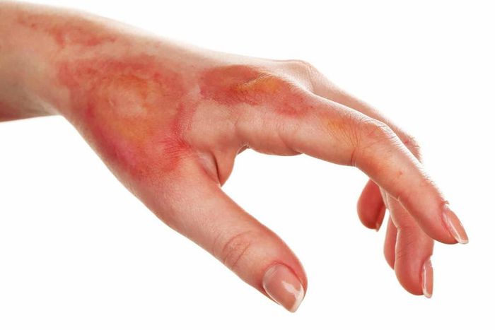 Here is how to heal burns in fast and safe ways