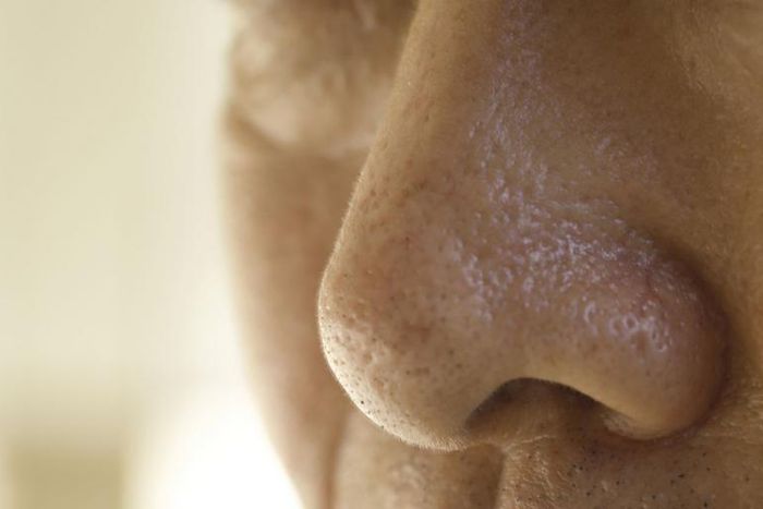 Dr. Pimple Popper Reshaped a Man's Nose