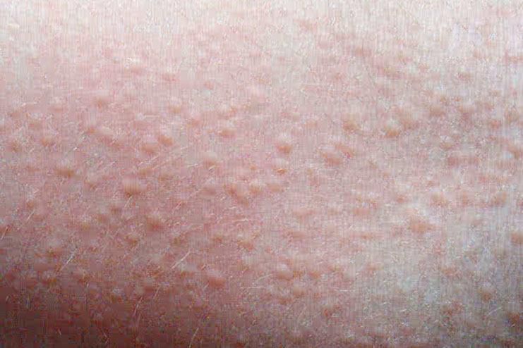 Here are rashes that could occur during pregnancy second trimester