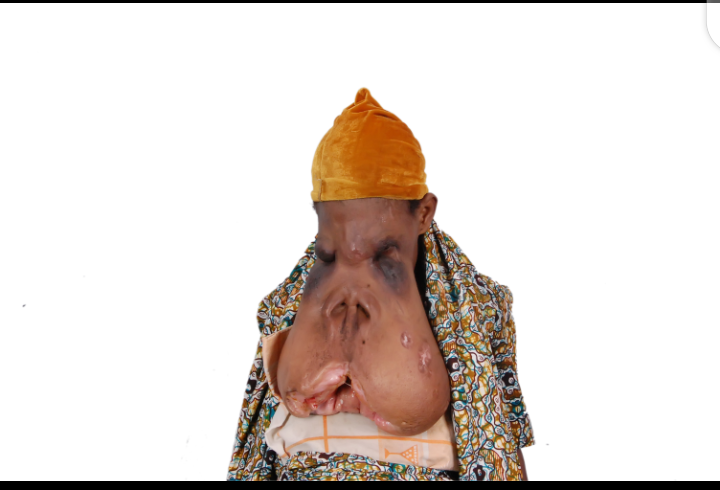 Facial tumor cancer patient deserted by husband and children seeks N5m for surgery in India