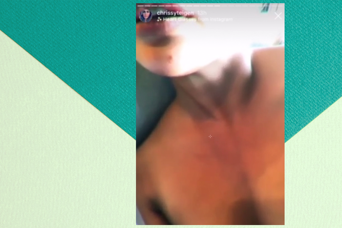 Why Chrissy Teigen Needs Dr. Pimple Popper's Help