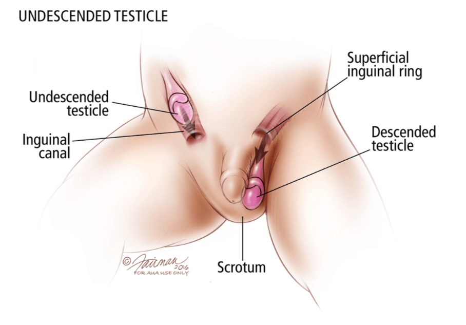 What are undescended testicles?