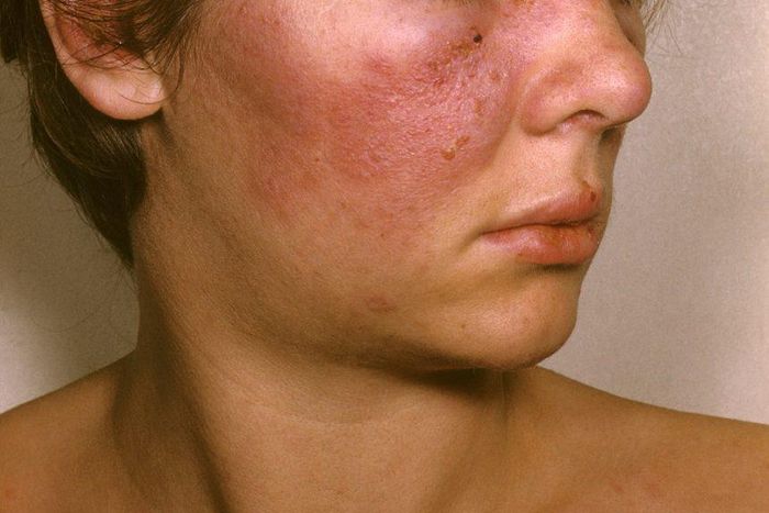 All you need too know about lupus, the deadly autoimmune disorder [Credit: Rheumatology Disorder]