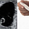 What is a blighted ovum: Causes, symptoms and treatment