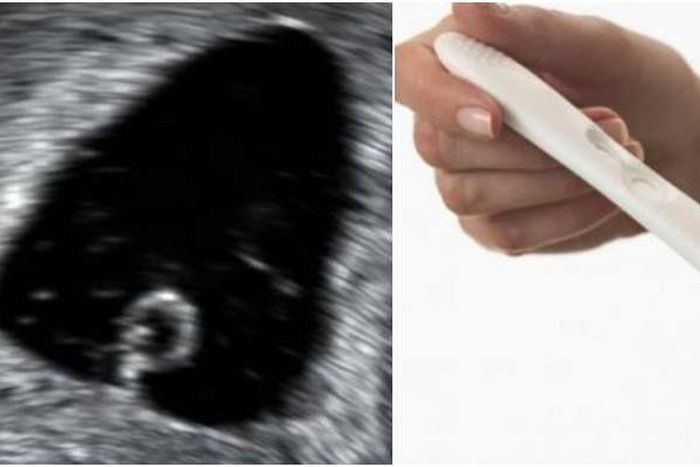 What is a blighted ovum: Causes, symptoms and treatment