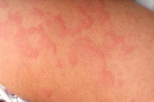 Here are rashes that could occur during pregnancy second trimester