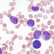 Would You Be Able To Spot These 7 Symptoms Of Leukemia?