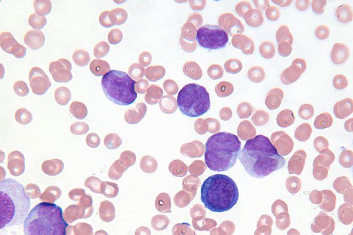 Would You Be Able To Spot These 7 Symptoms Of Leukemia?
