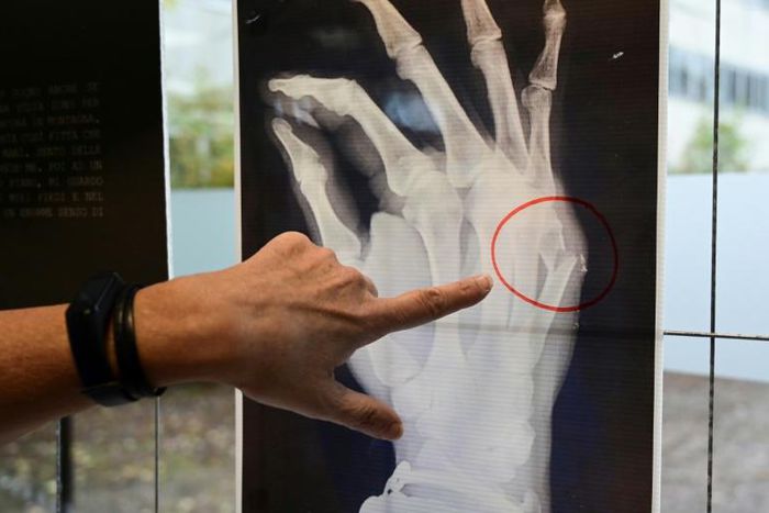 A Milan hospital is displaying X-rays from victims of domestic violence who have passed through the doors of the facility seeking help