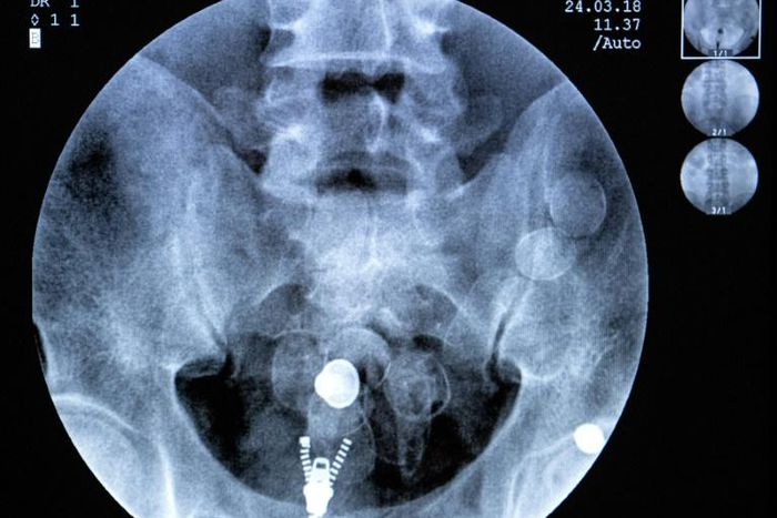 Long gone are the days of swallowing cocaine stuffed into condoms and closed up with scotch tape -- today's smugglers have gone high-tech. The Guyana pods are all the same: small, black, heat-sealed capsules about three centimetres (1.2 inches) wide