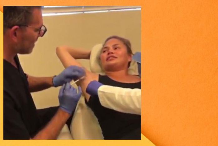 Chrissy Teigen Got Botox In Her Armpits