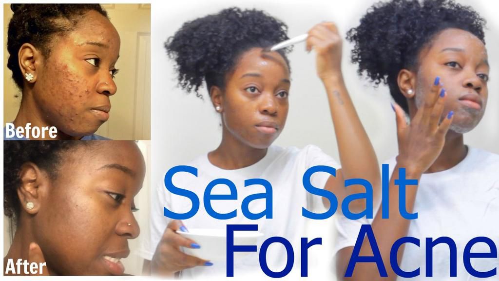 Sea salt to clear acne