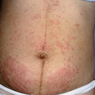 Here are rashes that could occur during pregnancy second trimester
