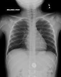 Here's what to do if your child swallows a foreign object