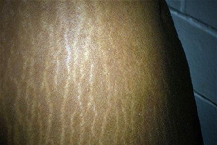 How to get rid of stretch marks with aloe vera