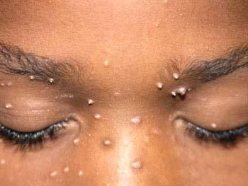 The best natural remedies for getting rid of warts