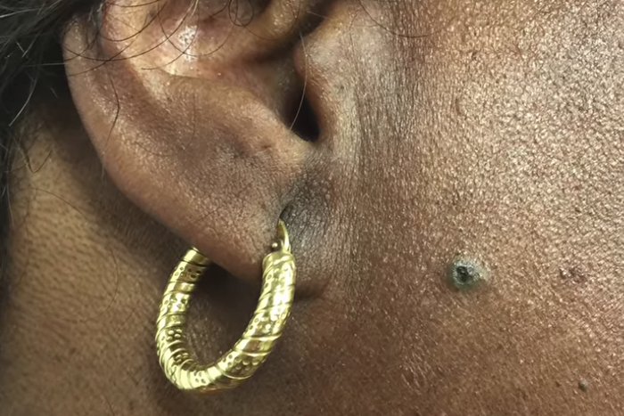 Dr. Pimple Popper Pops A 'Sticky' DPOW