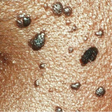 How to prevent skin tags: Safe methods of removal