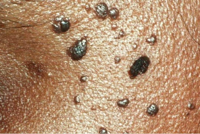 How to prevent skin tags: Safe methods of removal