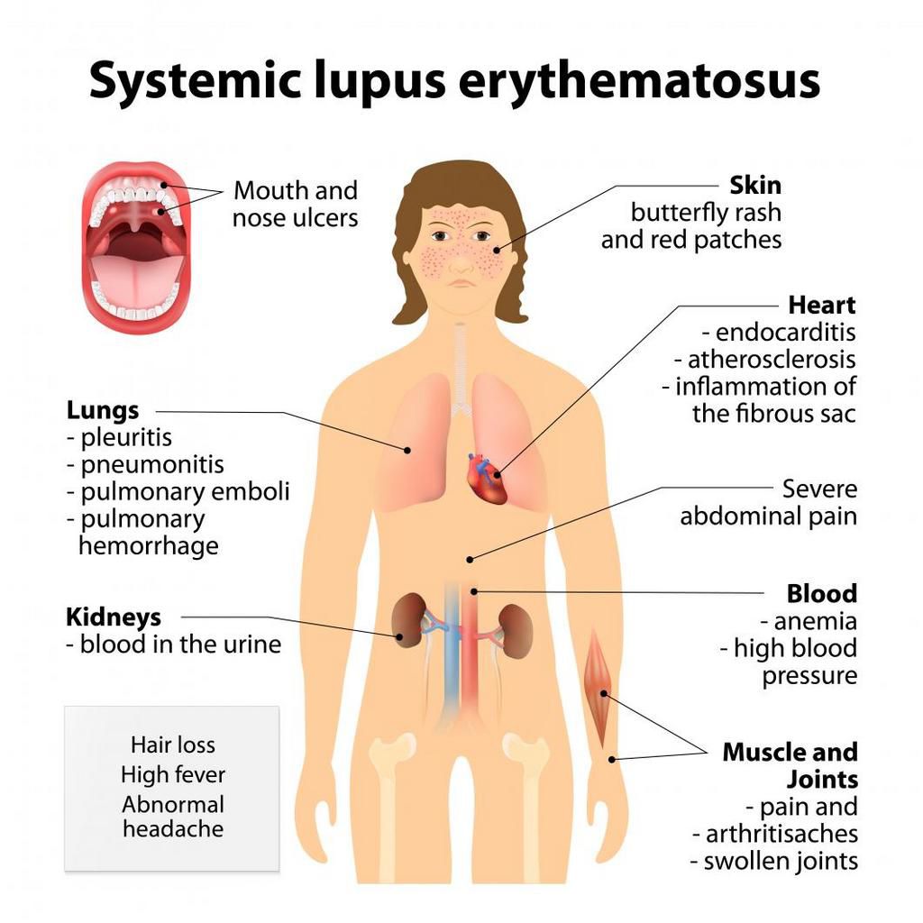 Lupus symptoms sheet [Credit: Creaky Joints]