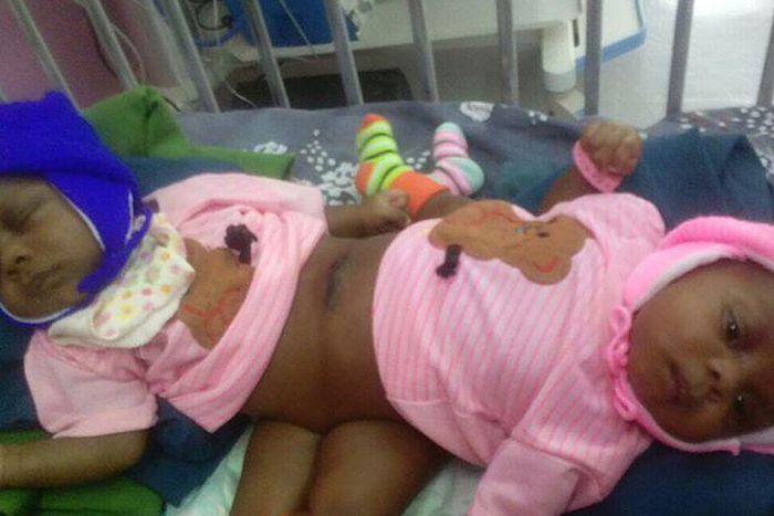 National Hospital records first conjoined twins separation. [bellanaija]