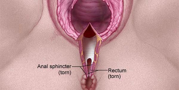 Causes and treatment of childbirth tears