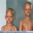 Ectodermal dysplasia: The agonies of 2 children with rare skin disorder/Photo used for the purpose of illustration.. [semanticscholar]