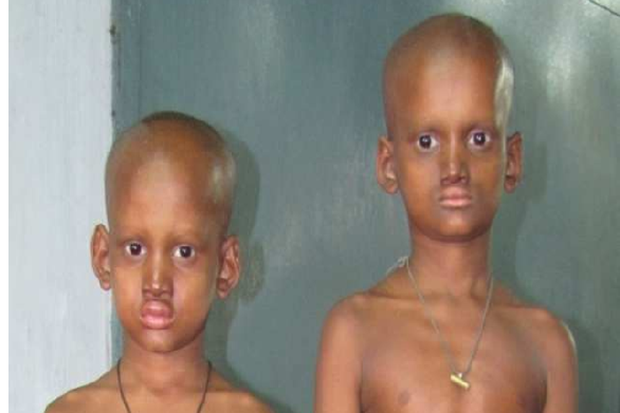 Ectodermal dysplasia: The agonies of 2 children with rare skin disorder/Photo used for the purpose of illustration.. [semanticscholar]