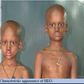 Ectodermal dysplasia: The agonies of 2 children with rare skin disorder/Photo used for the purpose of illustration.. [semanticscholar]