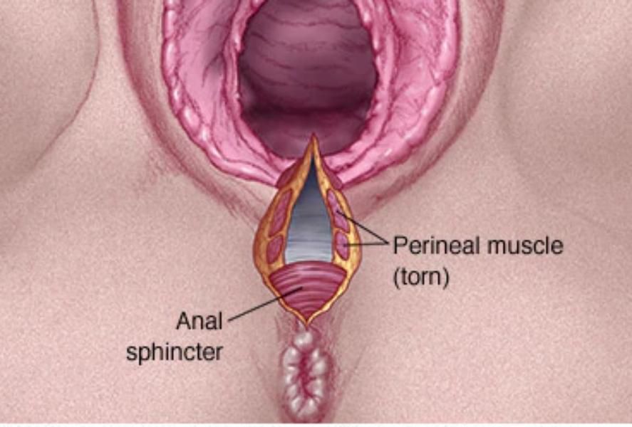Causes and treatment of childbirth tears