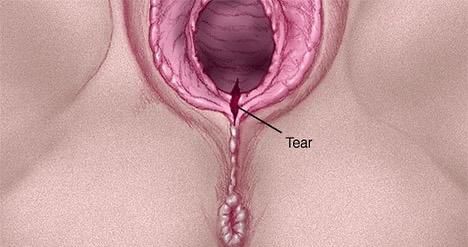 Causes and treatment of childbirth tears