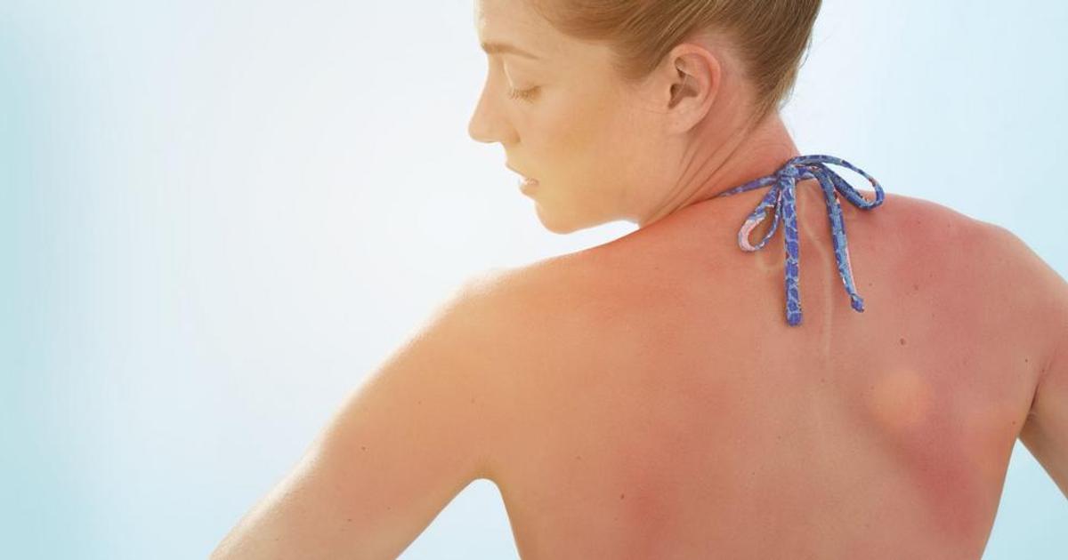 This Is What Sun Poisoning Looks Like—And Exactly What To Do If You ...