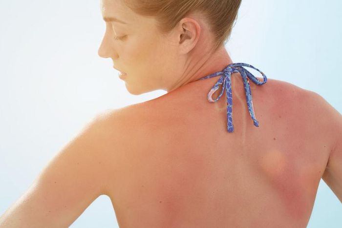 These Photos Show What Sun Poisoning Look Like