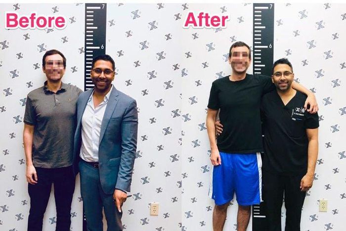 Men are now resorting to limb extension surgery to become taller (video)