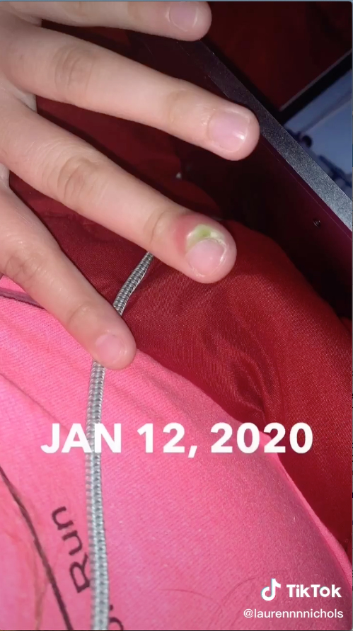Teen Warns Against Nail Biting After Infection