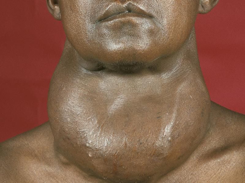 Everything you should know about the symptoms of hyperthyroidism